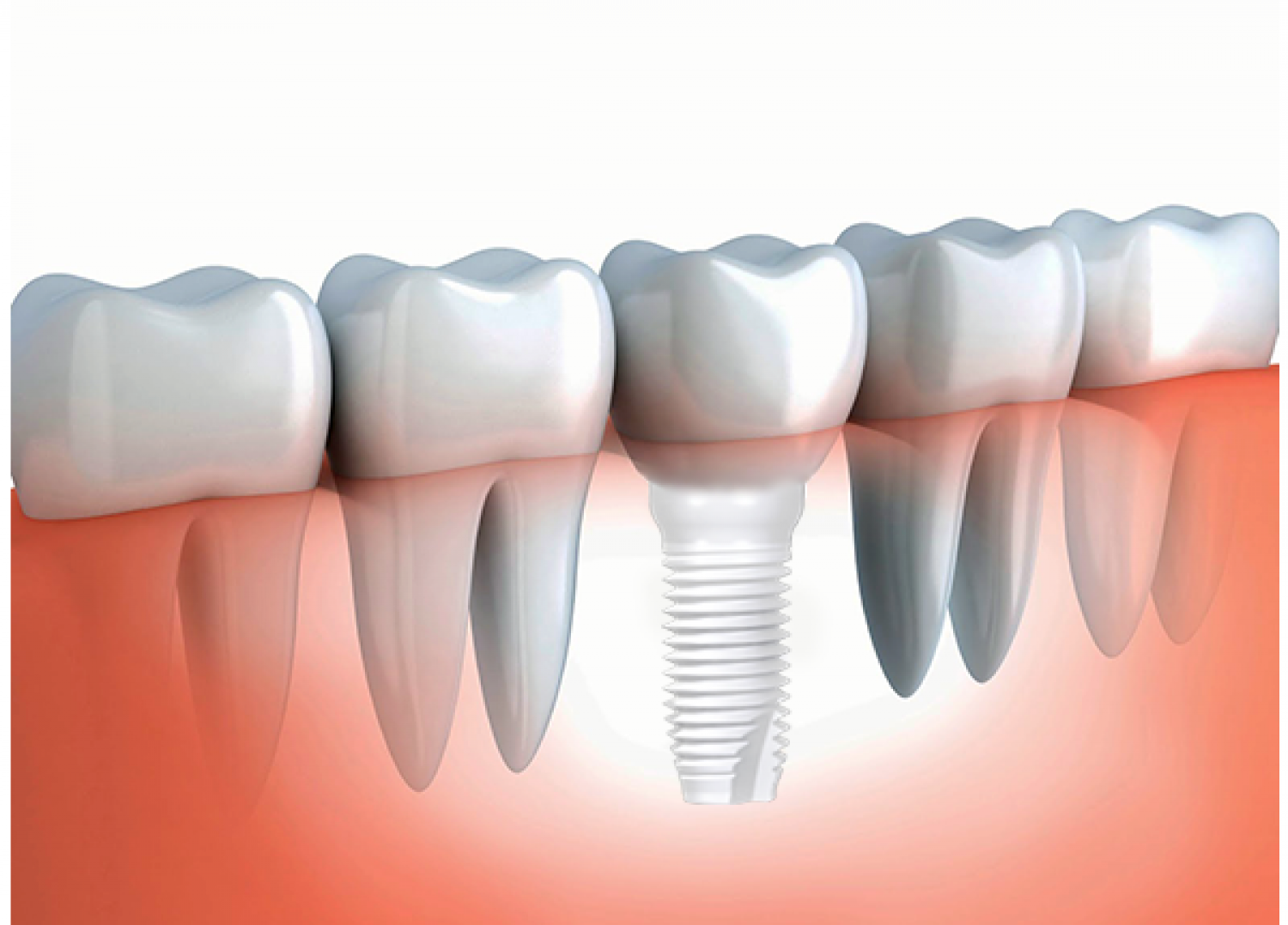 The Application of Zirconia Ceramics in Oral Medicine Field