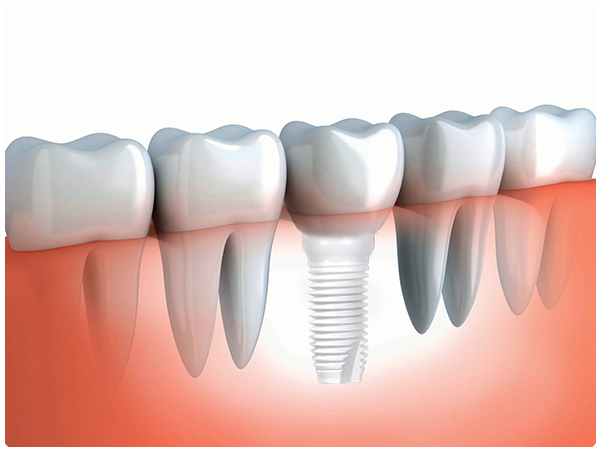 Dental Implant Teeth Ceramic