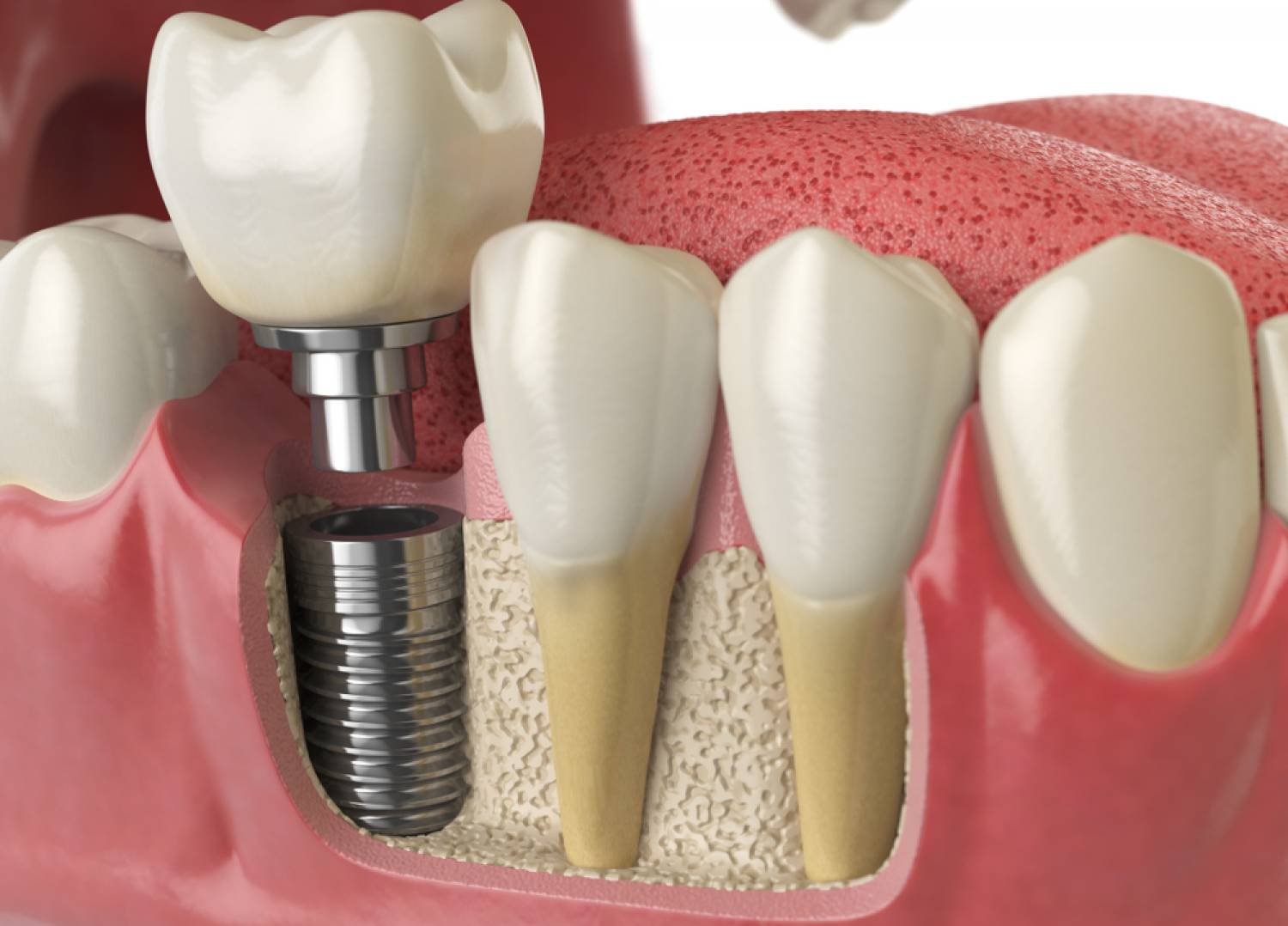 Zirconia Ceramics For Crown Implants Application