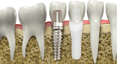 dental-implant-titanium-img