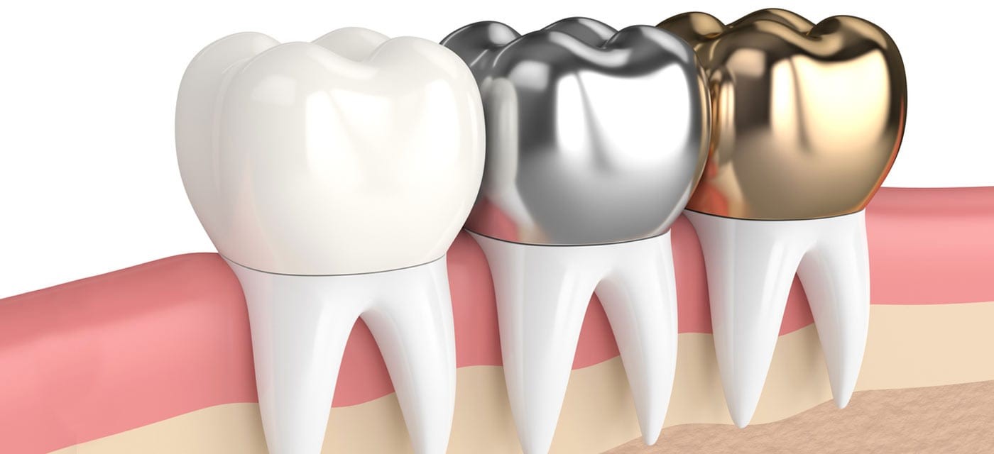 Dental Crowns Made of Different Materials